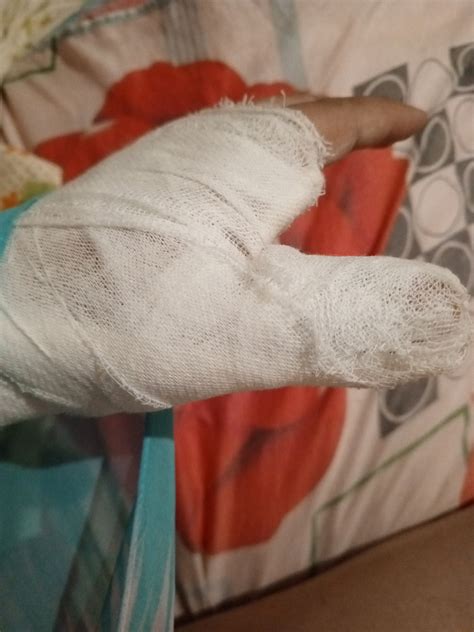 Сломан палец левой руки наложили гипс на пол руки Сломан палец левой ...