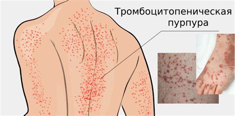 Лечение тромбоцитопении в клинике Семейный доктор в Москве