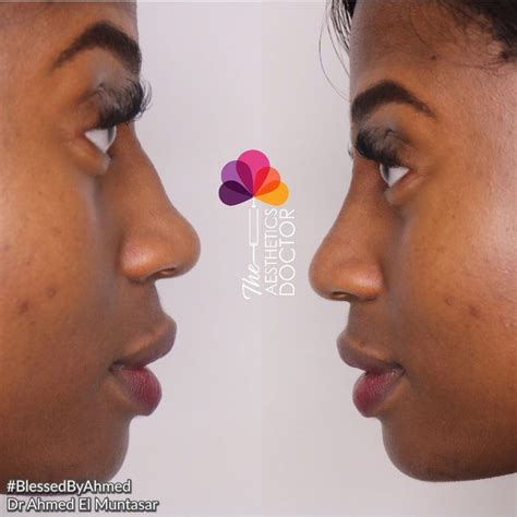 common  surgical rhinoplasty questions