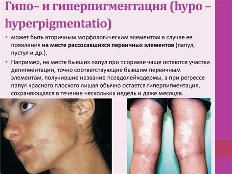 Морфологические элементы сыпи - презентация онлайн