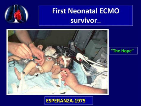 PPT - ECMO PowerPoint Presentation, free download - ID:7343122