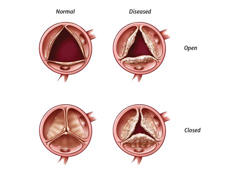 Heart Valve Disease Information | Edwards Lifesciences