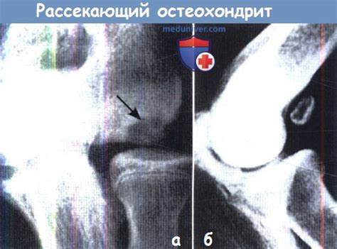 Симптомы рассекающего остеохондрита локтевого сустава и его лечение