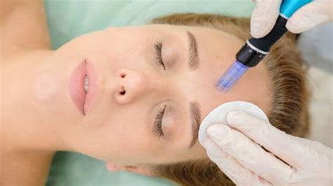 Micro Needling: What Is The Process About? - Stylishster