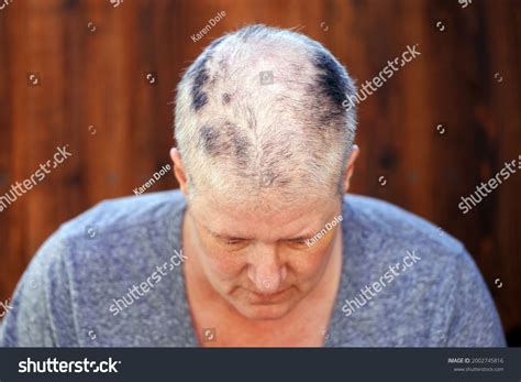 9 Patchy bald spots Images, Stock Photos & Vectors | Shutterstock