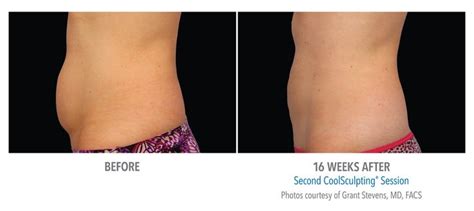 diy coolsculpting at home - Marlana Neuman