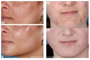 acne treatment options  complete guide