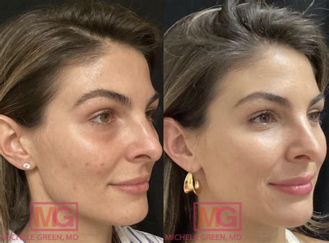 Acne Scars Before And After Chemical Peel