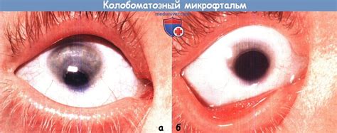 Причины и варианты микрофтальма у ребенка