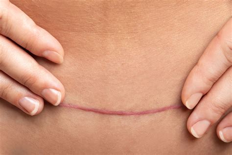 C-Section Scar Healing - 1 Amazing Treatment For Numbness