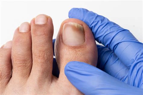 Tipos de Micose de Unha: Conheça as Diferenças e Tratamento