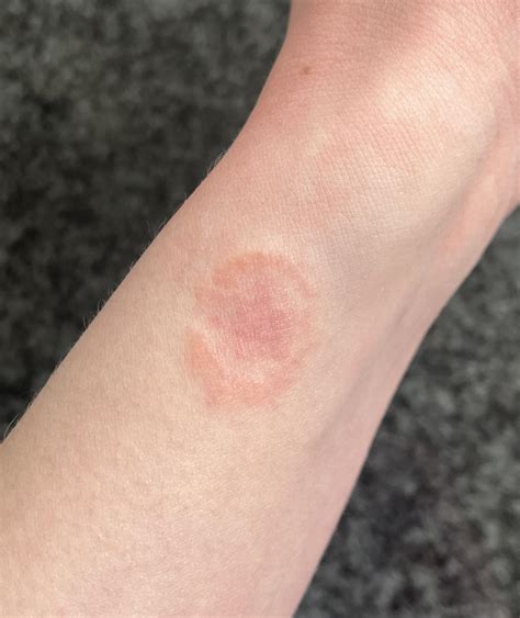 Circular Rash : r/DermatologyQuestions