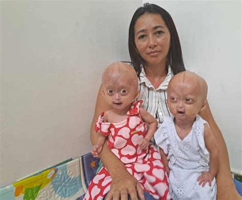 Doença Envelhecimento Precoce - Fatos Sobre Progeria Colombiana Com Doença Rara De Envelhecimento