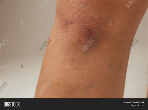 Hematoma Large Bruise Image & Photo (Free Trial) | Bigstock