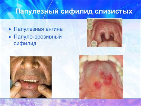 Сифилис - презентация онлайн