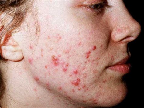 [Figure, Acne Vulgaris DermNet New Zealand] - StatPearls - NCBI Bookshelf