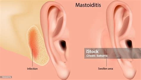 Mastoiditis Inflammation Of The Mucosal Lining Of The Mastoid Antrum ...