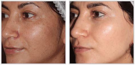Advanced Treatments | Pura Skincare