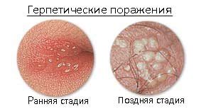Прыщи на анусе: причины, фото на нем, возле и вокруг