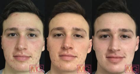 Accutane Before And After Body