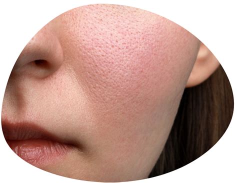 textured skin treatment dermdox skin solutions