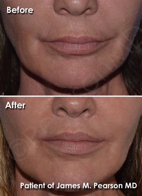 Corner Lip Lift - Dr. James Pearson Facial Plastic Surgery