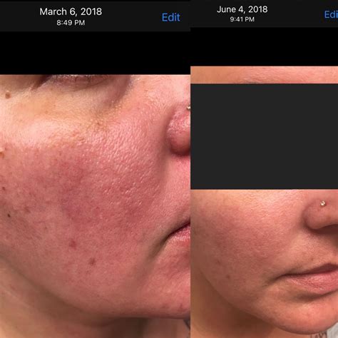 Laser treatment : r/Rosacea