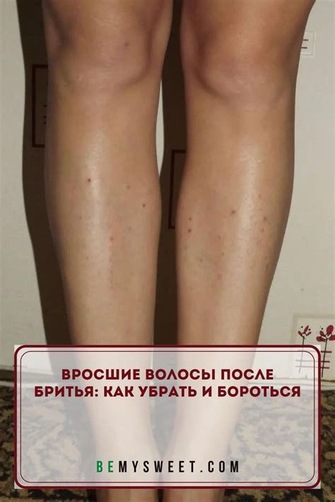 Вросшие волосы после бритья: как убрать и бороться | Beauty, Hair ...
