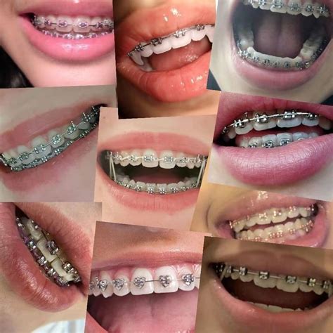 dream braces silver braces color silver braces  yellow teeth