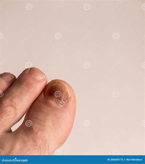 A Bruised Finger after a Blow, a Bruise on the Finger Stock Image