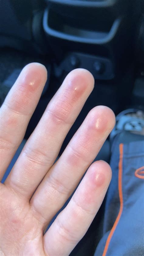 Fingertips Bruised? Swollen? : r/medicalmysteries