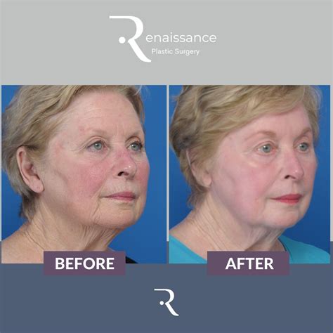 Phenol Peel Before and After - Renaissance Plastic Surgery