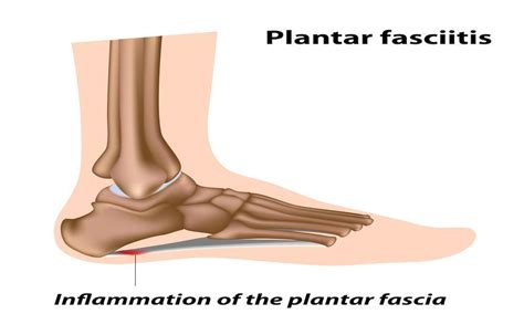 Plantar Fasciitis : Mercer Ocean Podiatry: Board-Certified Podiatrists ...