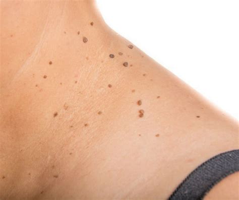 O Que É Fibroma Mole - O que são Acrocórdons ou Fibromas Moles? - Dra. Cinthia Orasmo ...