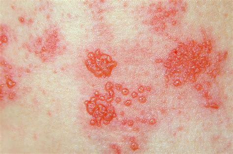 How Long Does It Take For Shingles Rash To Go Away at Barbara Cameron blog