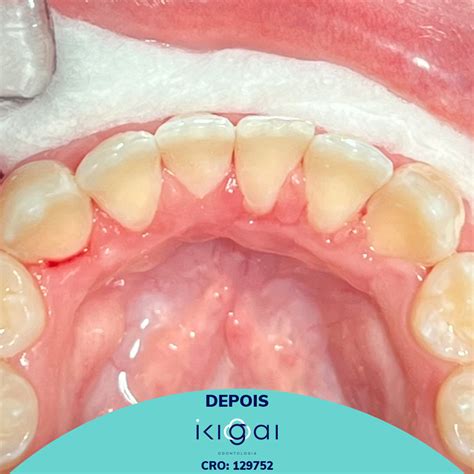 Raspagem Antes E Depois - Raspagem Periodontal Antes E Depois - RETOEDU