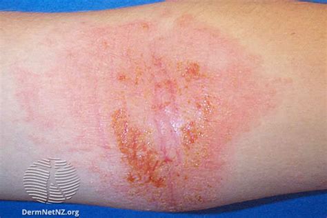 Dyshidrotic Eczema Pictures Treatment Causes