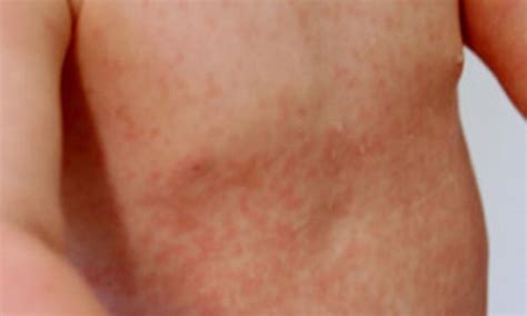 Rubella | NHS inform