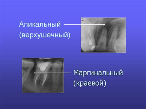 Периодонтит временных зубов у детей - презентация онлайн