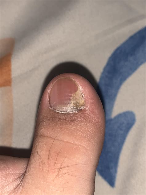 Nail Fungus: real advice from real people for healthy toenails and ...