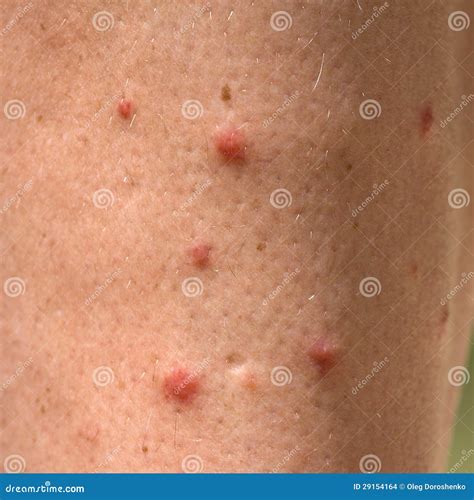 Allergic Rash Dermatitis Eczema Skin Of Patient. Man Itchind Skin With