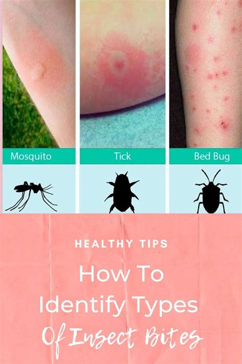 Insect Bites - How To Identify Types Of Insect Bites | Insect bites ...