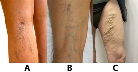 Tipos de Varices - varicesbarcelona 🧑‍⚕️