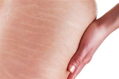 O Que Causa Estrias Na Adolescência - Estrias na adolescência Veja como evitar ou acabar com elas