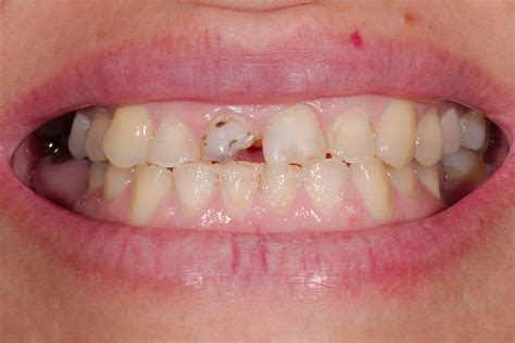 Chipped Molar No Pain