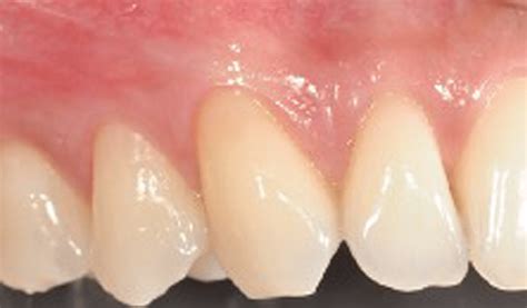 Guided Tissue Regeneration | Pocket Dentistry