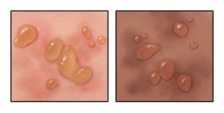 Bullous Pemphigoid: What It Is and How to Treat It | Memorial Sloan ...