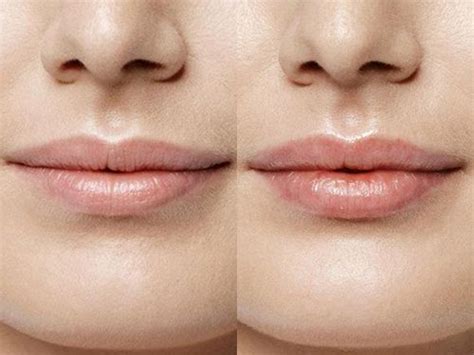 Рестилайн (Restylane): что это такое, виды, цены, фото до и после ...