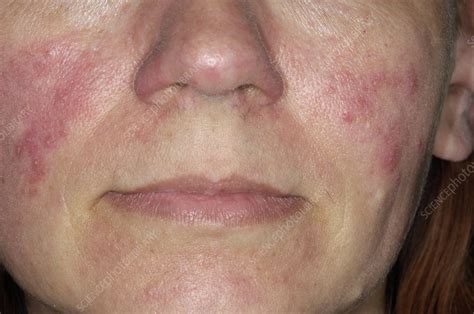 Acne Rosacea Forehead