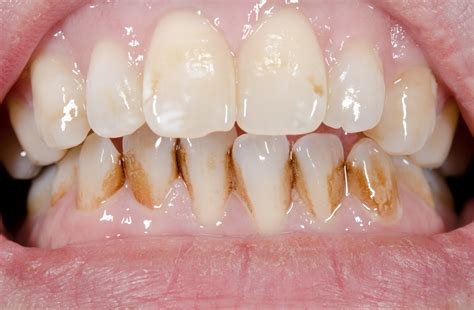 loose  teeth negative effects  treatment options living